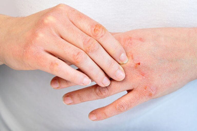 جفاف-الجلد.-6-أعراض-و6-طرق-للوقاية-منها-تجنب-الماء-الساخن