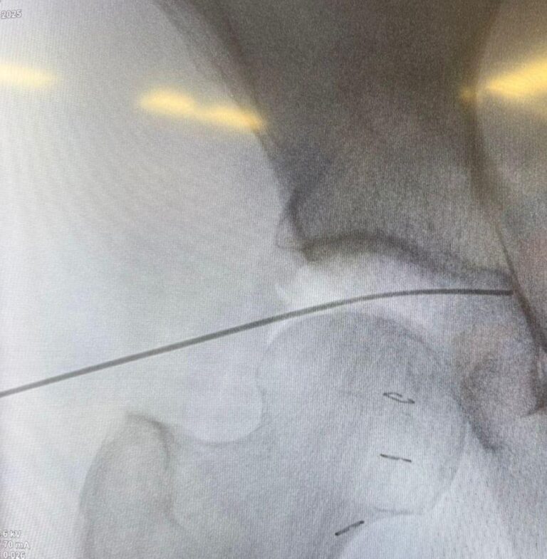 جراحة-بالمنظار-في-المدينة-المنوّرة-تُنقذ-مستفيدة-من-تمزّق-غضروف-الورك