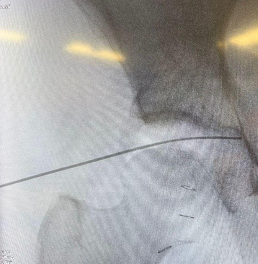 جراحة-بالمنظار-في-المدينة-المنوّرة-تُنقذ-مستفيدة-من-تمزّق-غضروف-الورك