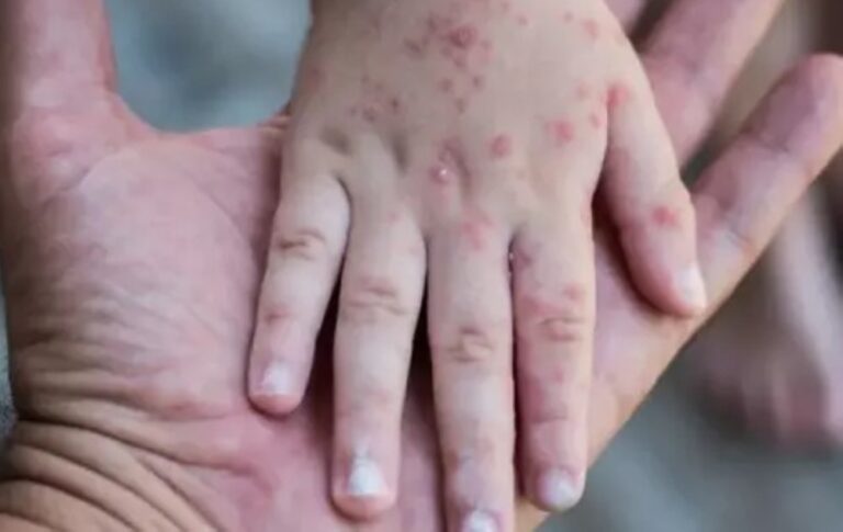 وفاة-11-طفلًا-بوباء-الحصبة-في-مقاطعة-ناباك-شمال-أوغندا