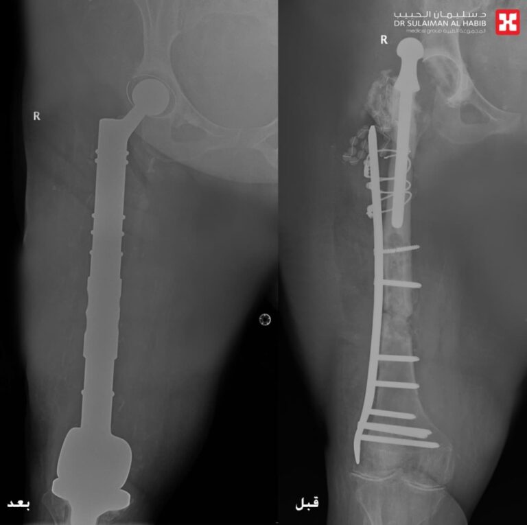 مستشفى-الدكتور-سليمان-الحبيب-بالخبر-يستبدل-مفصلي-الركبة-والورك-وعظمة-الفخذ-ويزيل-ورما-وزنه-“20”-كجم-ويعيد-“الحركة”-لـ”ستينية”