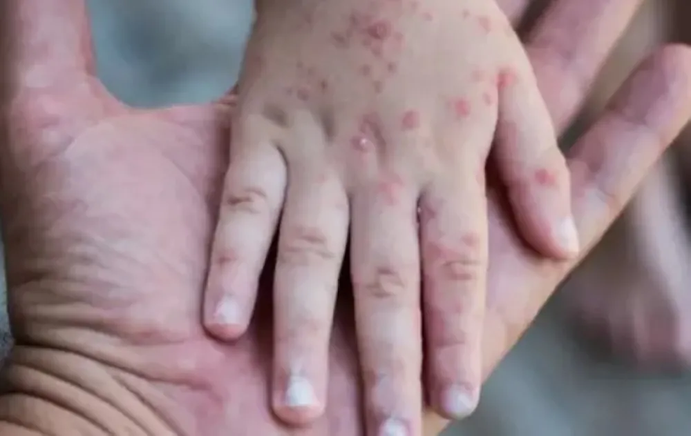 منع-59-مليون-حالة-وفاة.-التلقيح-يخفض-إصابات-الحصبة-عالميًا-بـ-71%