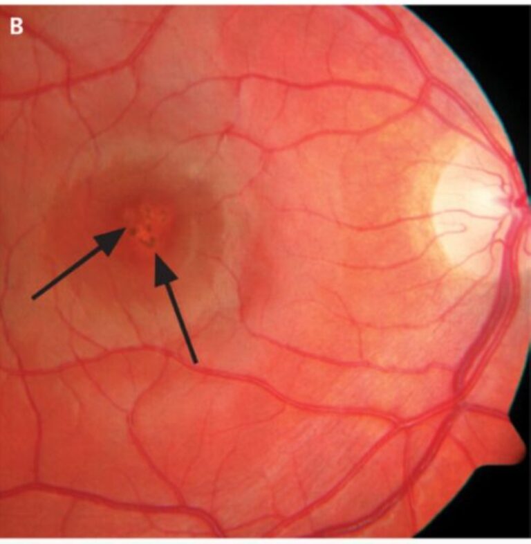 اختصاصي-عيون-لـ«اليوم»:-أجهزة-الليزر-الصغيرة-قد-تسبب-فقدان-البصر-في-لحظة