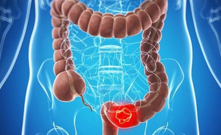 دراسة-مهمة-تكشف-عن-مسببات-جديدة-لسرطان-القولون-والمستقيم