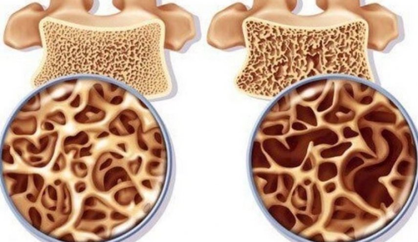 طريقة-صينية-قد-تغير-معالم-الكشف-عن-هشاشة-العظام