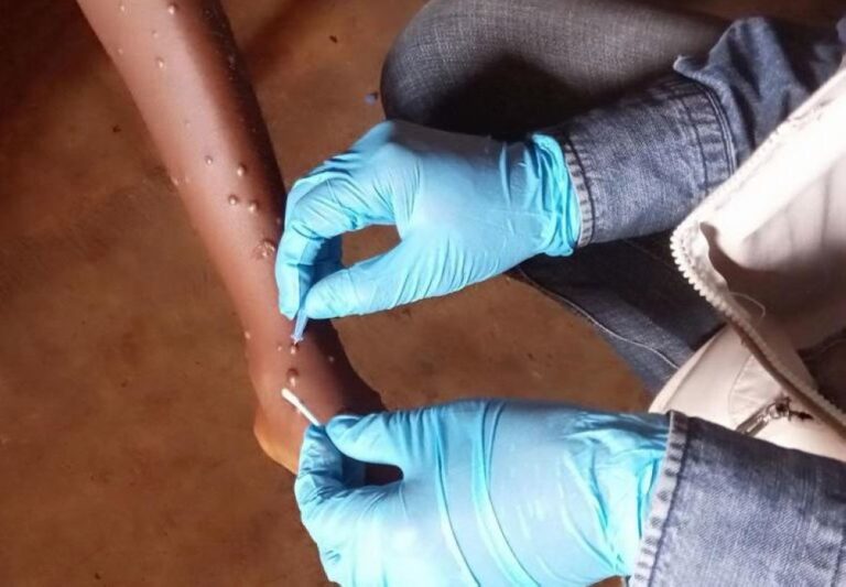 يضم-سلالتين.-“الصحة-العالمية”-تعلن-رصد-حالتين-لمتحور-جدري-القرود