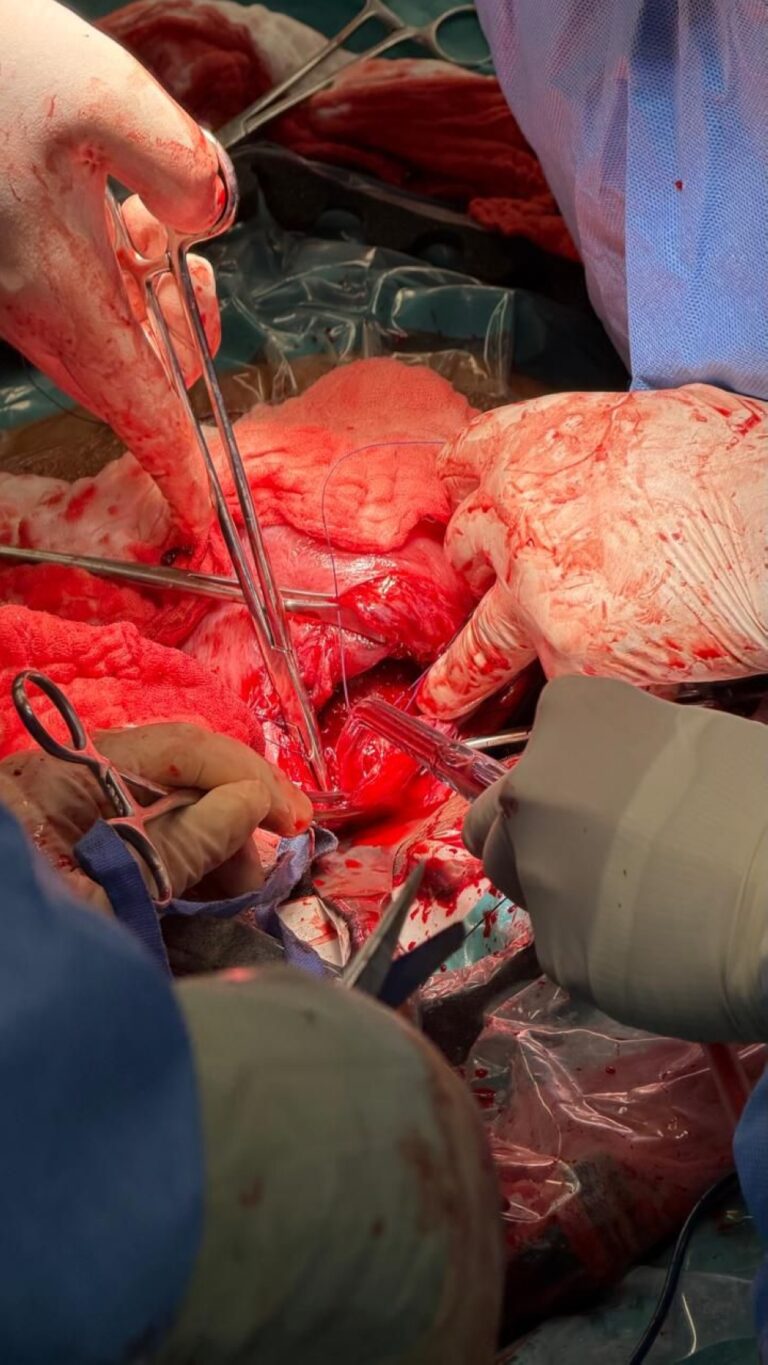 تقنية-متقدمة-بمدينة-الملك-سعود-الطبية-للسيطرة-على-نزيف-الولادة-دون-استئصال-الرحم