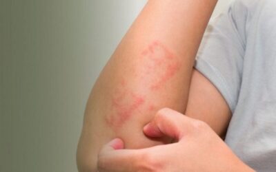 7 ملايين مصاب بطفيلي «شاغاس» عالمياً.. والمملكة تسجل معدلات صفرية