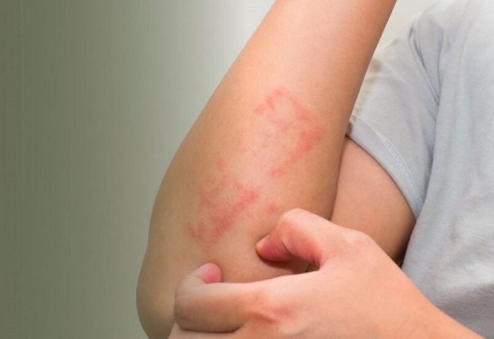 7 ملايين مصاب بطفيلي «شاغاس» عالمياً.. والمملكة تسجل معدلات صفرية