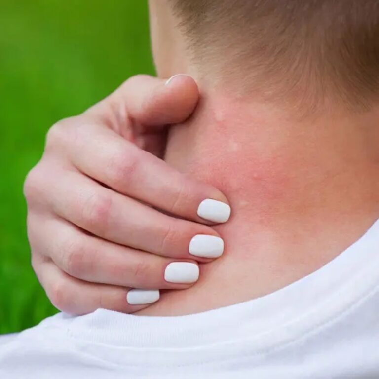 اليوم-العالمي-لمرض-شاغاس.-دعوة-عالمية-للانتباه-إلى-مرض-خطير-“مهمل”