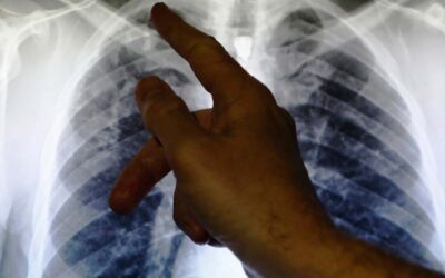 ابتكار تقنية جديدة بمستشعر صغير لتشخيص أمراض الرئة خلال دقائق