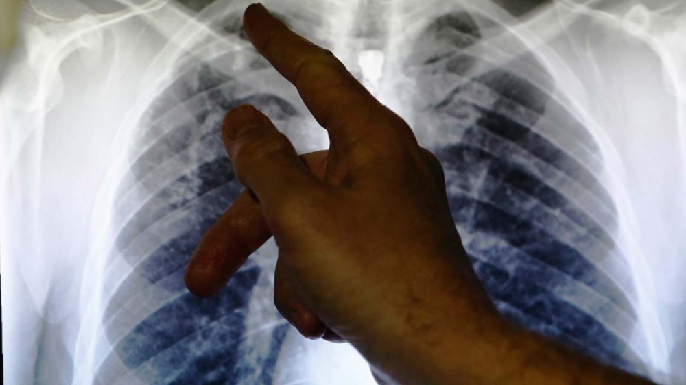 ابتكار تقنية جديدة بمستشعر صغير لتشخيص أمراض الرئة خلال دقائق