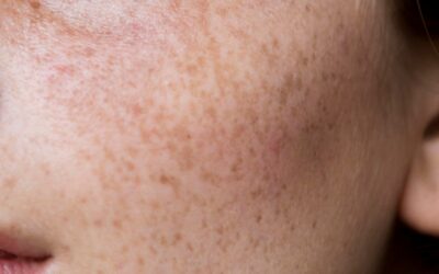 حالة جلدية شائعة.. تعرف إلى أهم أسباب فرط تصبغ البشرة