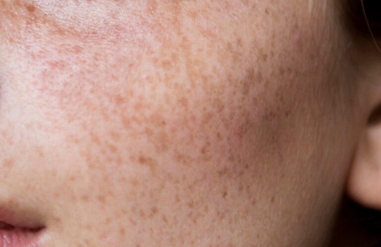 حالة-جلدية-شائعة.-تعرف-إلى-أهم-أسباب-فرط-تصبغ-البشرة