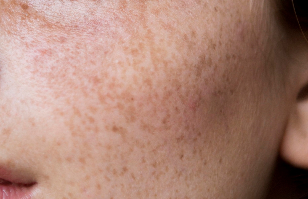 حالة جلدية شائعة.. تعرف إلى أهم أسباب فرط تصبغ البشرة