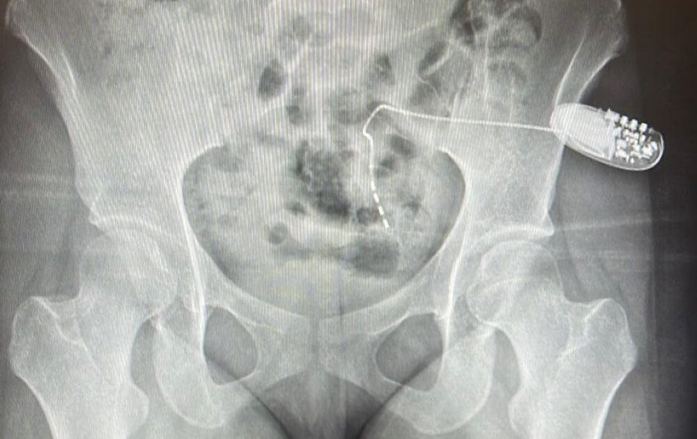 سعود الطبية: زراعة جهاز التحفيز العصبي العجزي لعشرينية تعاني من الاحتباس البولي 