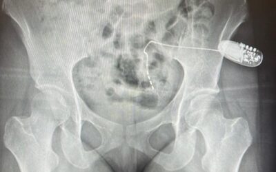 سعود الطبية: زراعة جهاز التحفيز العصبي العجزي لعشرينية تعاني من الاحتباس البولي 