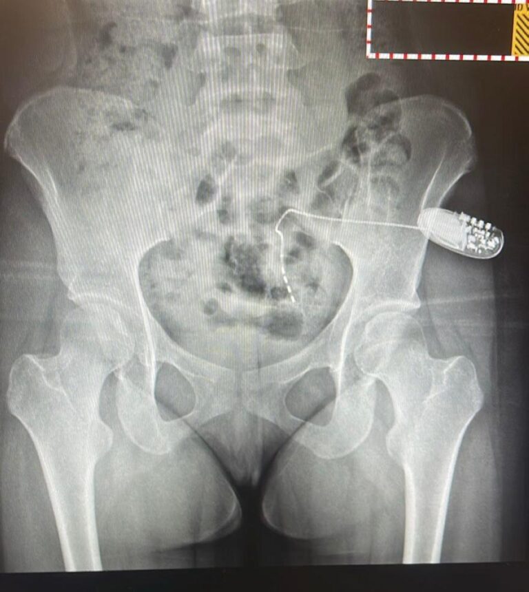 سعود-الطبية:-زراعة-جهاز-التحفيز-العصبي-العجزي-لعشرينية-تعاني-من-الاحتباس-البولي 