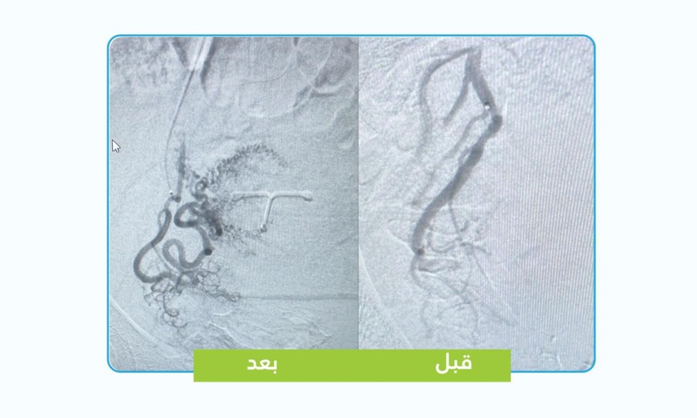 بتقنيات متقدمة.. إنهاء معاناة مريضة من تغدد الرحم دون تدخل جراحي