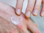 يسبب تسمم الدم بالبكتيريا.. سحب كريم شهير يعالج اﻷكزيما في أمريكا
