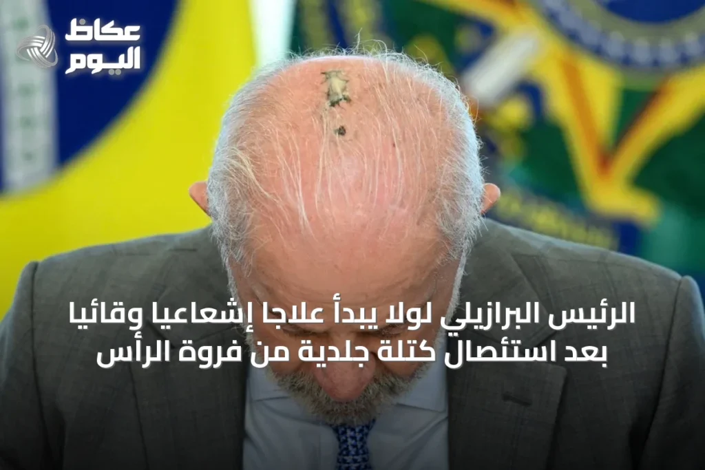الرئيس البرازيلي لولا يبدأ علاجاً إشعاعياً وقائياً بعد استئصال كتلة جلدية من فروة الرأس