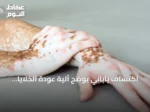 اكتشاف ياباني يوضح آلية عودة الخلايا الصبغية إلى حالة غير نشطة في البهاق