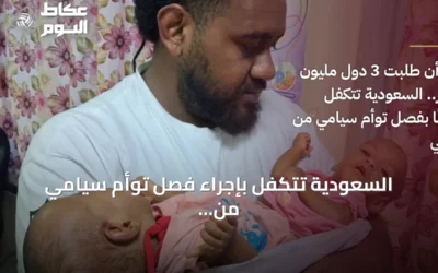 السعودية تتكفل بإجراء فصل توأم سيامي من فيجي مجانًا