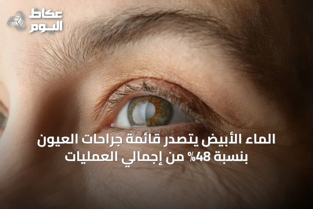 الماء الأبيض يتصدر قائمة جراحات العيون بنسبة 48% من إجمالي العمليات