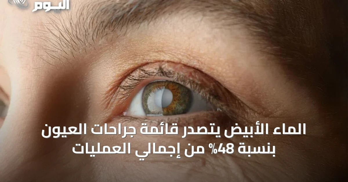 الماء الأبيض يتصدر قائمة جراحات العيون بنسبة 48% من إجمالي العمليات