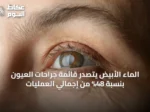 الماء الأبيض يتصدر قائمة جراحات العيون بنسبة 48% من إجمالي العمليات