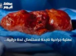 عملية جراحية ناجحة لاستئصال غدة درقية عملاقة تزن 2.5 كغ بمستشفى د. خالد الرحيمي