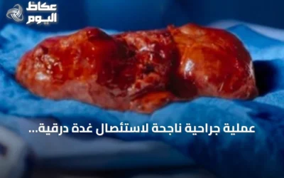 عملية جراحية ناجحة لاستئصال غدة درقية عملاقة تزن 2.5 كغ بمستشفى د. خالد الرحيمي