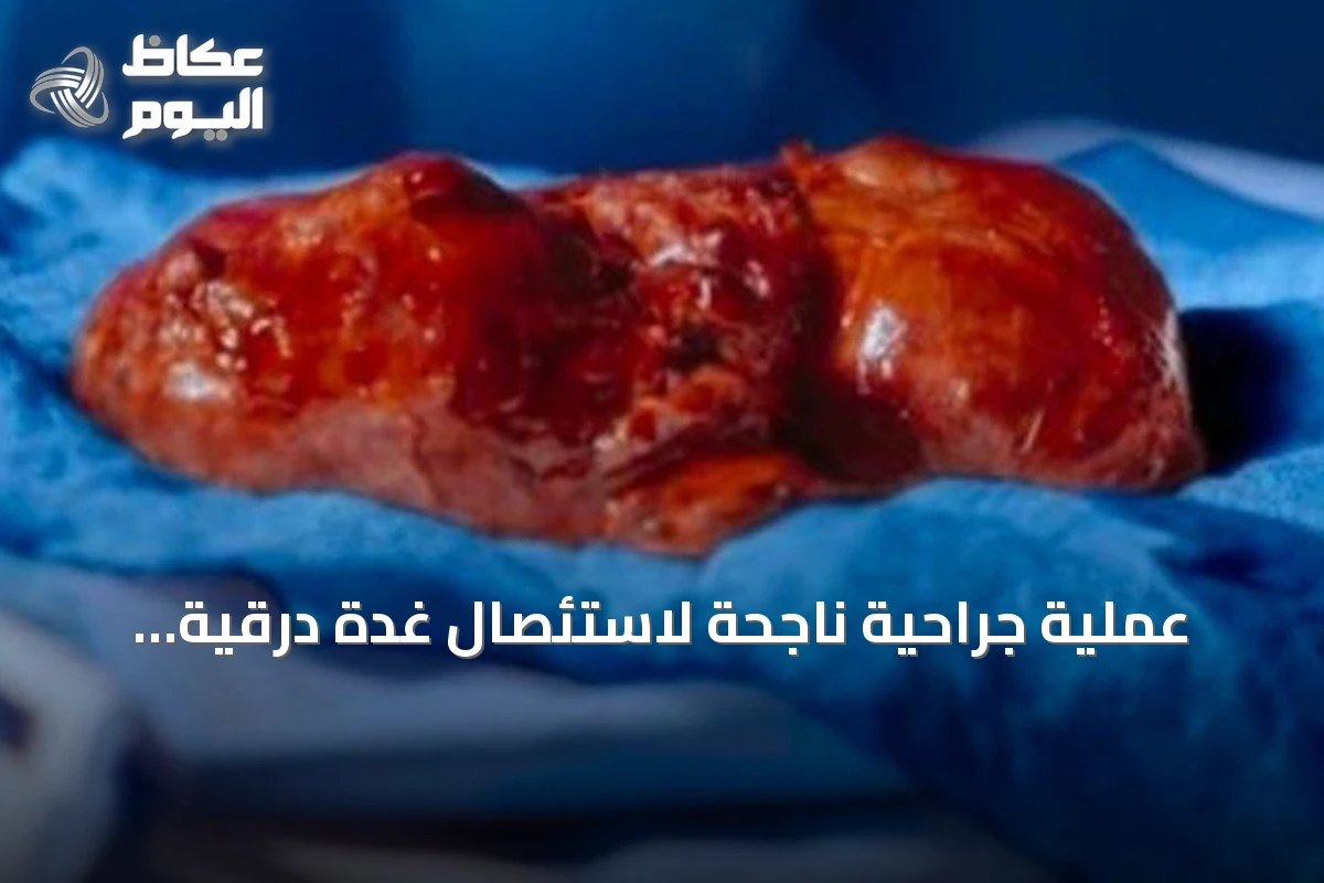 عملية جراحية ناجحة لاستئصال غدة درقية عملاقة تزن 2.5 كغ بمستشفى د. خالد الرحيمي