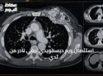 استئصال ورم ديسمويدي ليفي نادر من ثدي مريضة بنجاح فريق طبي سعودي