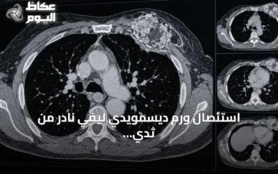 استئصال ورم ديسمويدي ليفي نادر من ثدي مريضة بنجاح فريق طبي سعودي