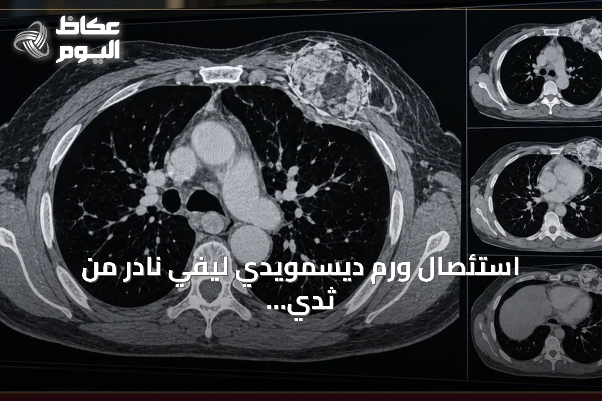 استئصال ورم ديسمويدي ليفي نادر من ثدي مريضة بنجاح فريق طبي سعودي